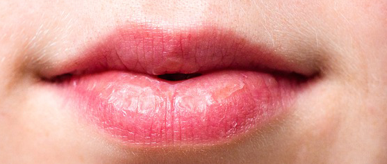 Can anxiety cause a dry mouth?